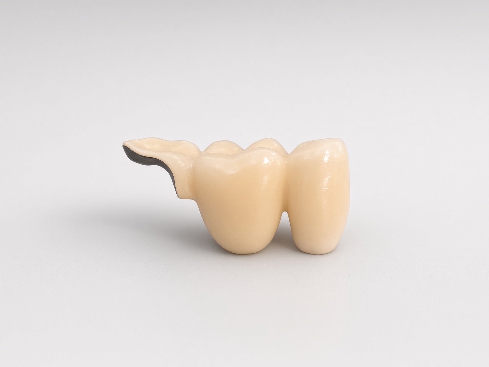 Metal-ceramic restoration.